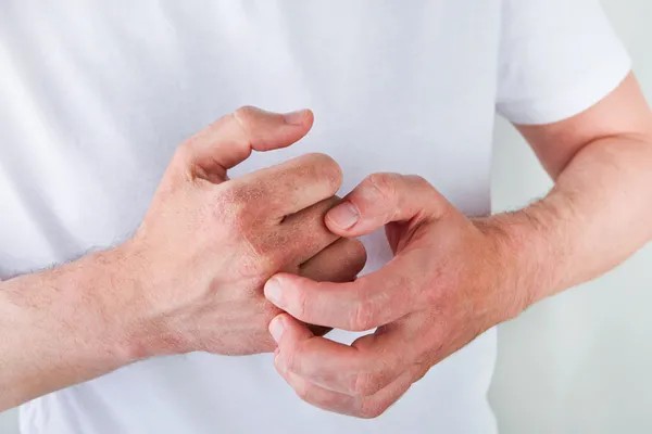 Uzmanlardan kış egzaması uyarısı: Bu alışkanlığı bırakın